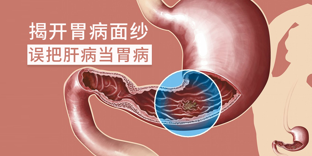 警惕“假胃病”，小心是肝有問題
